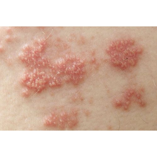 skin diseases
