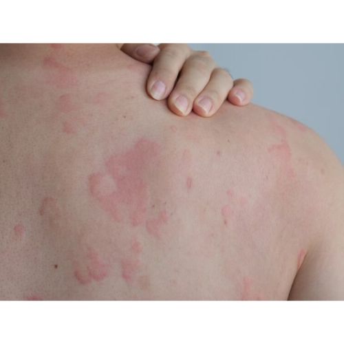 शीतपित्त (Hives Sit Pit)